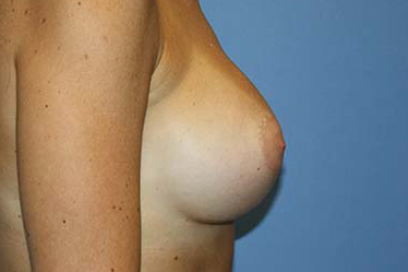 Breast Augmentation Before & After Patient #5748