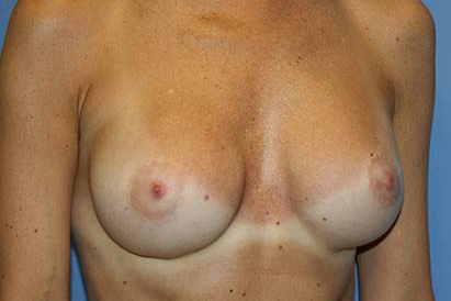 Breast Augmentation Before & After Patient #5748