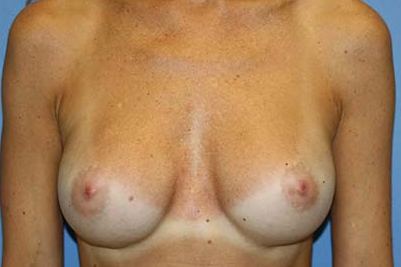 Breast Augmentation Before & After Patient #5748