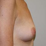 Breast Augmentation Before & After Patient #5748