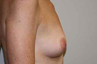 Breast Augmentation Before & After Patient #5748