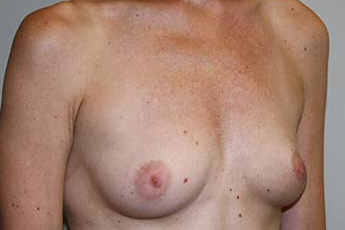 Breast Augmentation Before & After Patient #5748