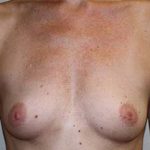 Breast Augmentation Before & After Patient #5748