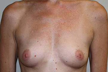 Breast Augmentation Before & After Patient #5748