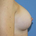 Breast Augmentation Before & After Patient #5751