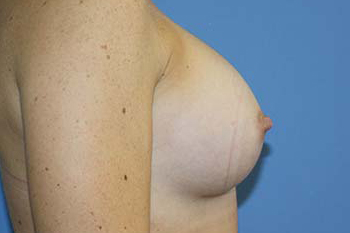 Breast Augmentation Before & After Patient #5751