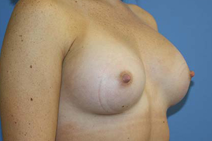 Breast Augmentation Before & After Patient #5751