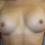 Breast Augmentation Before & After Patient #5751