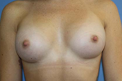 Breast Augmentation Before & After Patient #5751