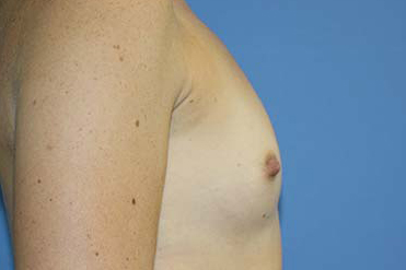 Breast Augmentation Before & After Patient #5751