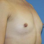 Breast Augmentation Before & After Patient #5751