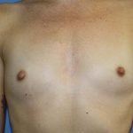 Breast Augmentation Before & After Patient #5751