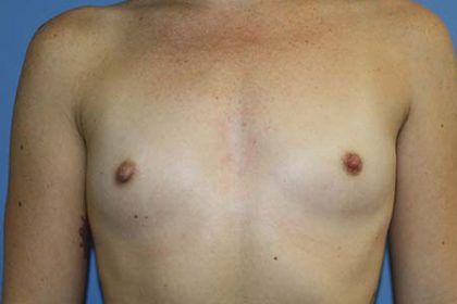 Breast Augmentation Before & After Patient #5751