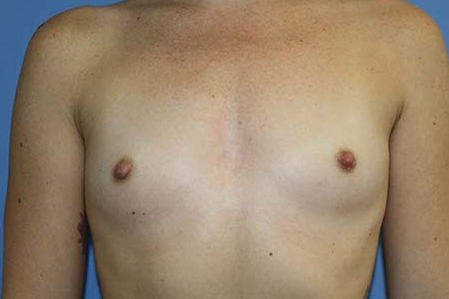 Breast Augmentation Before & After Patient #5751