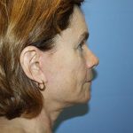 Facelift Before & After Patient #5752