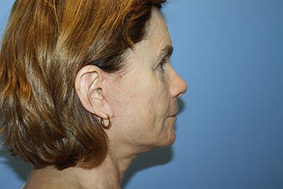 Facelift Before & After Patient #5752