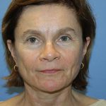 Facelift Before & After Patient #5752