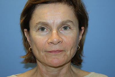 Facelift Before & After Patient #5752
