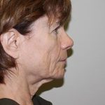 Facelift Before & After Patient #5752