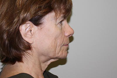 Facelift Before & After Patient #5752