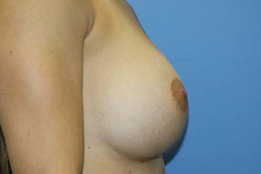 Breast Augmentation Before & After Patient #5596