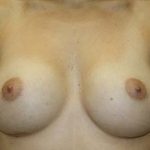 Breast Augmentation Before & After Patient #5596