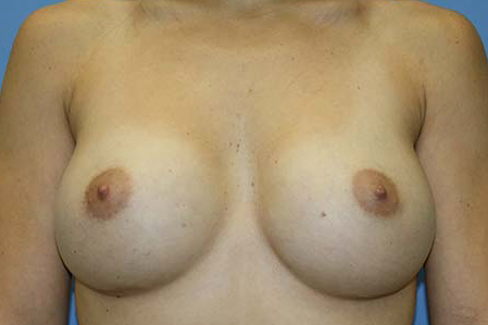 Breast Augmentation Before & After Patient #5596