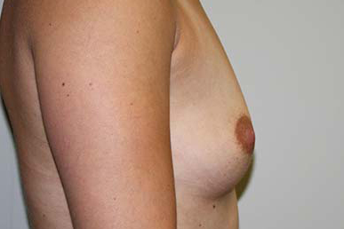 Breast Augmentation Before & After Patient #5596