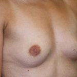 Breast Augmentation Before & After Patient #5596