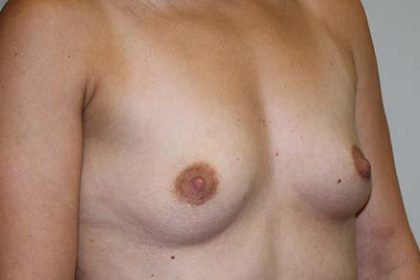 Breast Augmentation Before & After Patient #5596