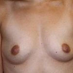 Breast Augmentation Before & After Patient #5596