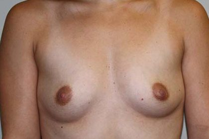 Breast Augmentation Before & After Patient #5596