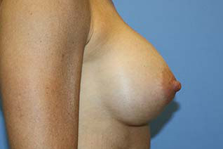 Breast Augmentation Before & After Patient #7162