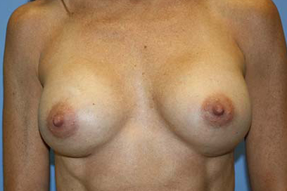 Breast Augmentation Before & After Patient #7162