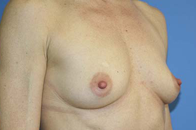 Breast Augmentation Before & After Patient #7162