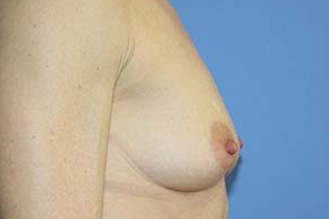 Breast Augmentation Before & After Patient #7162