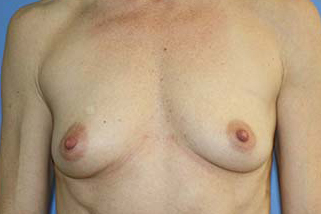 Breast Augmentation Before & After Patient #7162