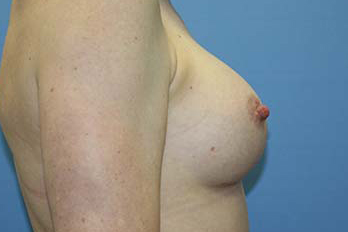 Breast Augmentation Before & After Patient #5606