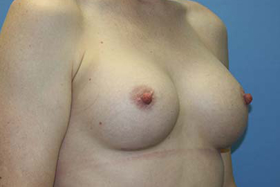 Breast Augmentation Before & After Patient #5606