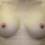 Breast Augmentation Before & After Patient #5606