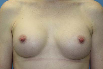 Breast Augmentation Before & After Patient #5606