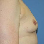 Breast Augmentation Before & After Patient #5606