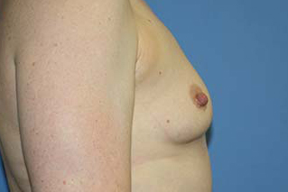 Breast Augmentation Before & After Patient #5606