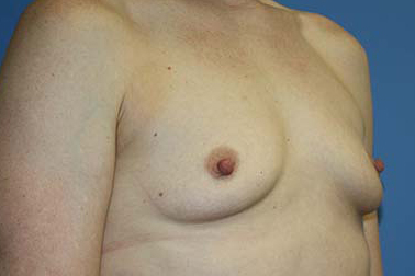 Breast Augmentation Before & After Patient #5606