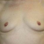 Breast Augmentation Before & After Patient #5606