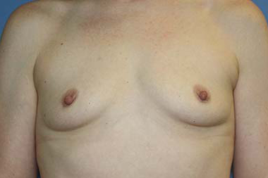 Breast Augmentation Before & After Patient #5606