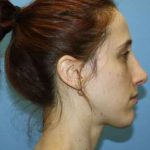 Nose Surgery Before & After Patient #5613