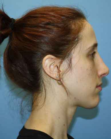 Nose Surgery Before & After Patient #5613