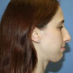 Nose Surgery Before & After Patient #5613