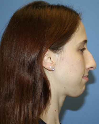 Nose Surgery Before & After Patient #5613